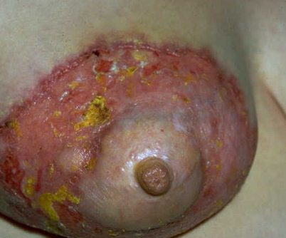 三期梅毒_疾病名称:三期梅毒 所属部位:就诊科